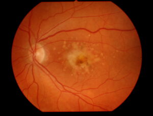 A microscopic image of the effect of Macular Degeneration on the retina.